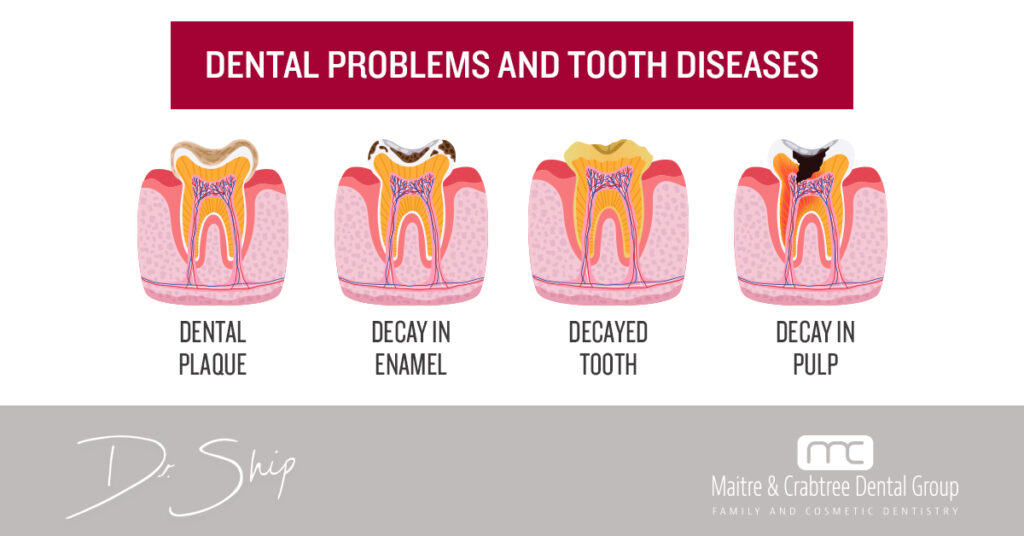 Learn The Warning Signs Of Cavities Ship Maitre Dmd 