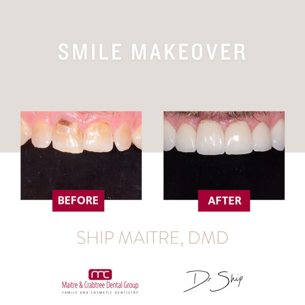 Dentist, Teeth, smile, patient, smile makeover, botox